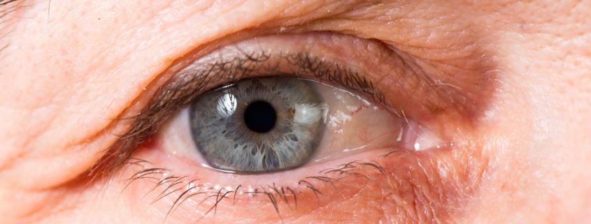 Die Uveitis - eine gefährliche Augenentzündung