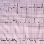 Was ist eigentlich ein EKG?