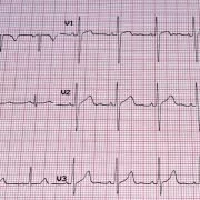 Was ist eigentlich ein EKG?
