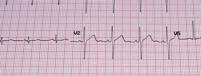 Was ist eigentlich ein EKG?