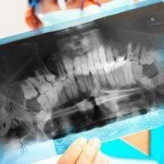 Zähneknirschen und die Ursache