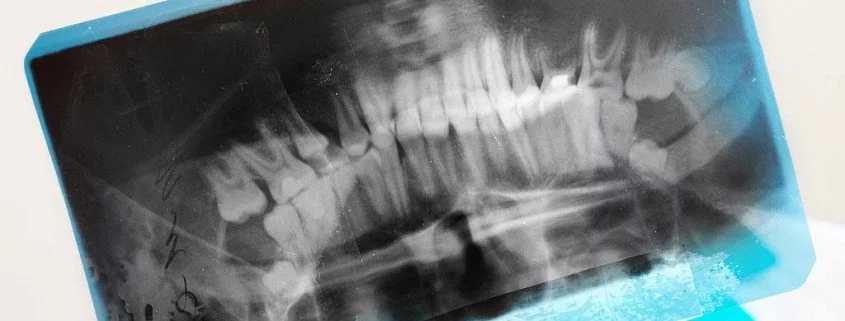 Zähneknirschen und die Ursache